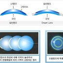 드림렌즈의 시술과정? 이미지