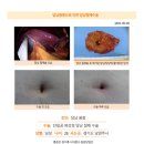 담낭용종수술후기. 인터넷에 검색을 하던 중 튼튼병원 김정윤 원장님이 유명하다는 얘길 듣고 예약 후 진료를 봤다. 이미지