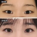 첫눈성형외과의원 네이버블로그