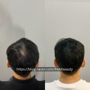 대머리는 아니지만.. 정수리가 비어서??!? 고민인남성 (파주 흐무뭇)