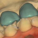 더하얀의원 | 신사역 치과. 아나운서 면접 전 앞니 벌어진 공간을 라미네이트로만 해결할 수 있었던 사연..