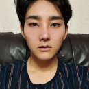 [스압주의] 남자 코 성형 후기 -2편- (코 재수술 후기)