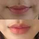 댕이멍이 | 신사역입술필러 1cc 가격, 통증, 붓기 내돈내산 후기