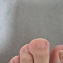 본병원 | [동탄 정형외과] 발가락 종양 의심｜감탄 vs 패스트본 병원 비교 후기