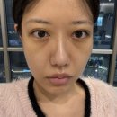 더이노써클 | 눈밑지방재배치병원 눈밑지방제거레이저 다크서클필러 시술 후기