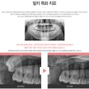 대건치과의원 | 인천사랑니전문치과 썩은 사랑니 방치or발치?