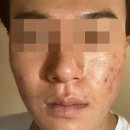동일한의원 | 여드름한의원 화농성, 뾰루지 치료했던 후기