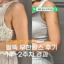 무한 | 인천웨딩다이어트, 팔뚝 무한람스 후기 1~2주차 (+멍, 붓기, 통증)