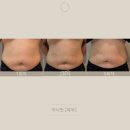 단 1회로도 눈에 띄는 변화!바디 근육 강화 &amp; 라인 개선 ‘이너핏’ 리얼 후기 공개
