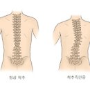 바테르증후군 증상 원인 치료 이미지