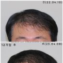 모발이식 후 관리하는 40대 남성 -동명정환 후기