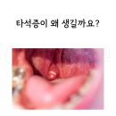오남이비인후과의원 | 침샘돌 통증 생기기 전 치료해야 하는 이유