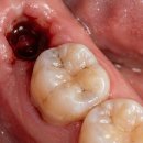 골든시니어치과의원 | 인계동 치과 추천 , 임플란트 후 '이거' 무조건 지켜주셔야합니다.