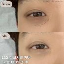 예, 그리다(YE, GRIDA) | 강남 다크서클 반영구, 시술 전 반드시 알아야 할 5가지