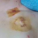 췌장암투병일기 (4편)---폴피리녹스 1차 항암치료---폴피리녹스 항암치료와 부작용
