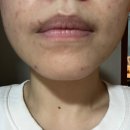 전주바른약국 | 먹었는데 4일차 피부 상태는 어떻게 됐을까? 리쥬란 2cc +물광주사 내돈내산 솔직후기 (도움되는 영양제)