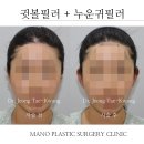 누운귀필러전후 통해 알아보는 누운귀 교정 방법