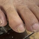 동성약국 | 산본 발톱무좀 풋네일 동성제약 풀리메디 군포산본점 솔직후기