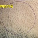 수원 SMP STUDIO본점 두피관리 줄기세포엑소좀 7회차 후기