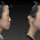 봄여름가을겨울피부과의원 | [파미지방이식 3D화면 전후 사진 케이스 비교] 돌출입 교정 사례