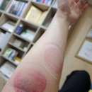 나무한의원 | 초음파로 통증 부위를 눈으로 확인해서 약침 놔주는 강변 향기나무한의원