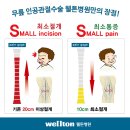 무릎인공관절수술의 효과/ 수술후 4시간 후 보행/ 수술비용/ 운동방법 이미지