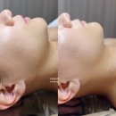 위례에스테틱 디유에스테틱 베이비페이스 관리 받은 후기