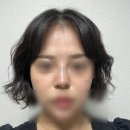 (주)다락방친구들 | 창원 하이코 슬라인코 리프팅 내돈내산 솔직 후기 (전 후 사진)
