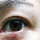 부평열린안과의원 | 부평열린안과의원 다래끼 방문