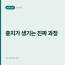 슬기로운군산치과의원 | 충치가 생기는 진짜 과정, 입속 세균이 이를 무너뜨리는 순서