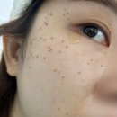 (주)사려니 | [사려니의원 편평사마귀 제거 일주일 후기] 시술 다음날부터 딱지관리까지 솔직 후기 🩵