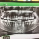 오페라치과의원 | 작년에 뽑은 사랑니 발치 후기. 대구오페라치과의원 후기