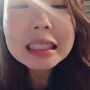 교정일기 Day1 : 대구 디에르치과에서 부분교정시작했어용