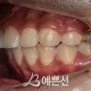 미소선치과의원 | 덧니 돌출입교정, 발치가 꼭 필요한 케이스는 어떤 경우일까요?