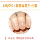 손톱 울퉁불퉁 건강의 이상신호 이미지