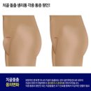 치골돌출된 애들 있냐…골반후방경사임 이미지