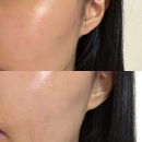 아로마벨피부과의원 | 피부과 레이저리프팅 후 진정크림 추천, 세벨리아 익스트림케어 솔직 후기
