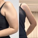 월차 | 부유방제거수술비용+팔지흡 3개 월차 후기