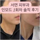 부산피부과 인모드 fx 1회 솔직후기 술,담배,멍 붓기 주의사항
