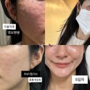 더한의원 | 지금 맞아야되는 화장잘먹 스킨부스터 강남한의원 PN리빌더 후기 (+새살침)