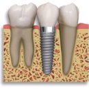 임플란트 해도 60%는 잇몸병 생겨… 예방법은 이미지