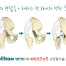 고관절 통증 원인 치료 바로알기! 이미지