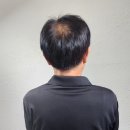 양산,울산두피문신 잘하는 곳 추천 정수리탈모 극복 내돈내산 후기"헤드라인유울산점"