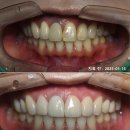 경주치과기공소 | 검은 치아 앞니 변색 착색 크라운으로 해결