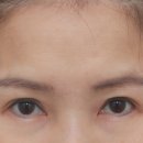 노블레스강영석성형외과의원 | 부산 이마거상 상담 시 꼭 확인해야 할 5가지 기준