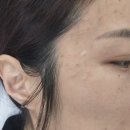 바른클린강북지사 | 수유 잡티기미제거 리유브로우 멜라리티 1회차 후기