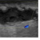 Abscess 와 봉와직염(세포염)의 차이,초음파상에서 구별 가능한가요? 이미지