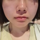 메디스코 | 메디스코 홈케어 해초필링 시너지필 각질 탈락 후기, 약초필링 가려움증