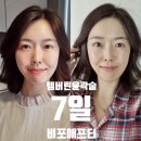 끌레어의원 | 끌레어클리닉 청담피부과 탬버린윤곽술 받고 갸름해진 후기(옆광대, 심부볼 일주일 비교)