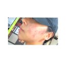 스위스의원 | 내돈내산 | 수원역 스위스의원에서 여드름 흉터 필러 맞고온 후기 ㅠㅠ (2만원 할인팁)